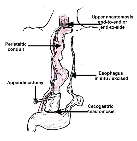 Sous-titution œsophagienne, gastro-entérologue en Inde